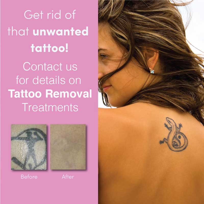 TattooRemoval5